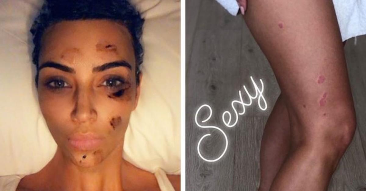 Kim Kardashian sur Instagram en 2019 partageant des photos de son psoriasis
