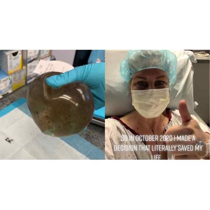 Kvinna upptäcker mögel i bröstimplantat efter att ha lidit okänd sjukdom i 10 år i Viral TikTok
